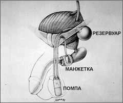 Искусственный сфинктер мочевого пузыря